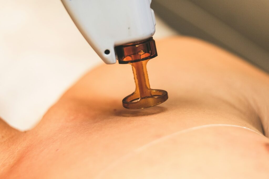 Close up of a laser handpiece on the skin
