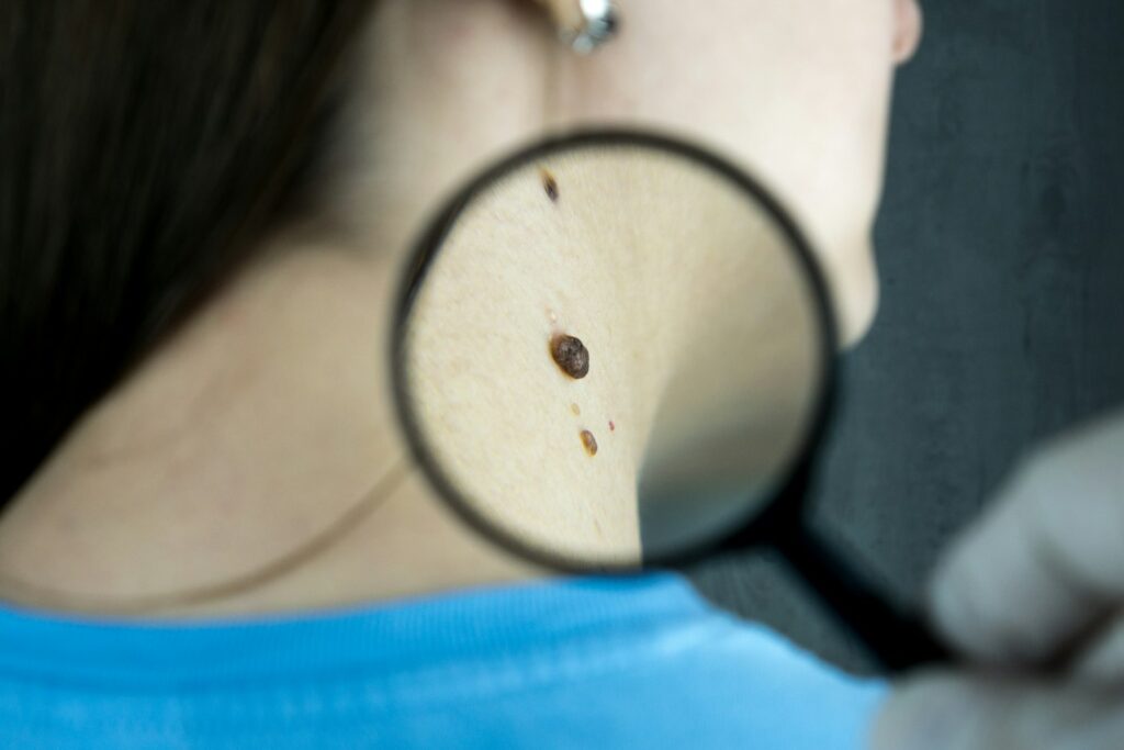 Magnifying glass used to check the skin closely