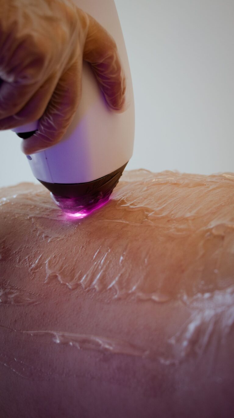 Tattoo removal scars are avoided with careful laser settings on the skin
