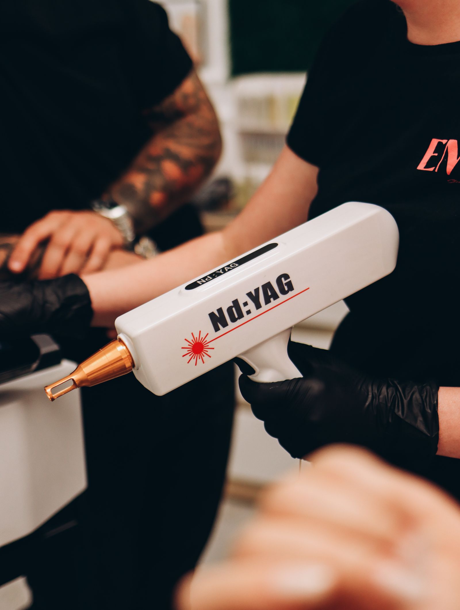 Pico laser tattoo removal vs Q-switch: Nd:YAG laser handpiece over a tattooed arm