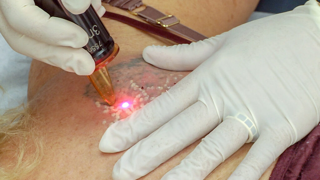 Q-switch laser tattoo removal session with white frosting on the treated ink