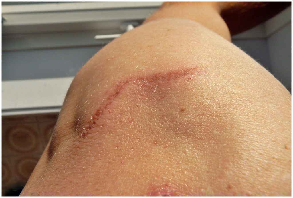 Raised scarring left after laser tattoo removal on the skin
